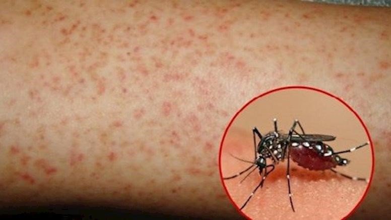 Thận trọng với loại virus gây bệnh sốt xuất huyết - Ảnh 1.