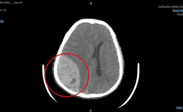 Nam thanh niên xuất huyết não sau khi đi bơi về - Ảnh 1.