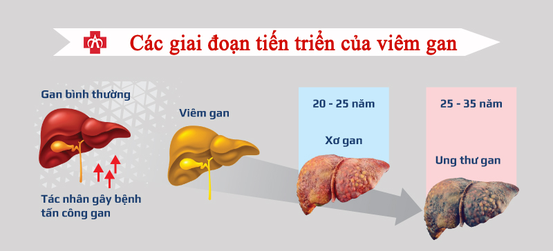 Viêm gan - căn bệnh diễn biến thầm lặng nhưng hậu quả nghiêm trọng - Ảnh 3.