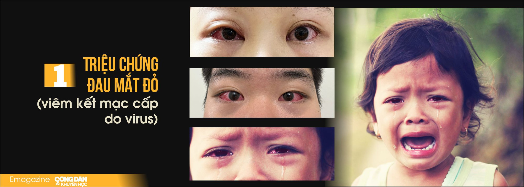 Bệnh đau mắt đỏ đang vào mùa dịch, những điều cần biết và cách phòng bệnh - Ảnh 2.