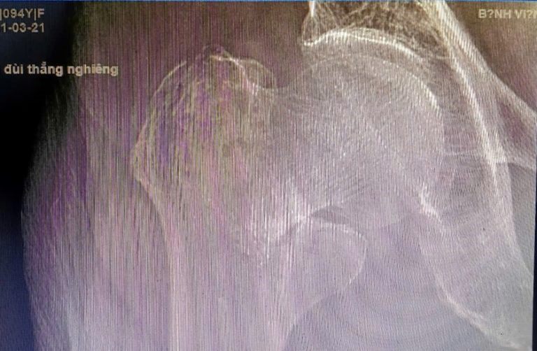 Bệnh viện đa khoa số 2 Lào Cai: Thay khớp háng thành công cho cụ bà 95 tuổi bị ngã gẫy cổ xương đùi - Ảnh 2.