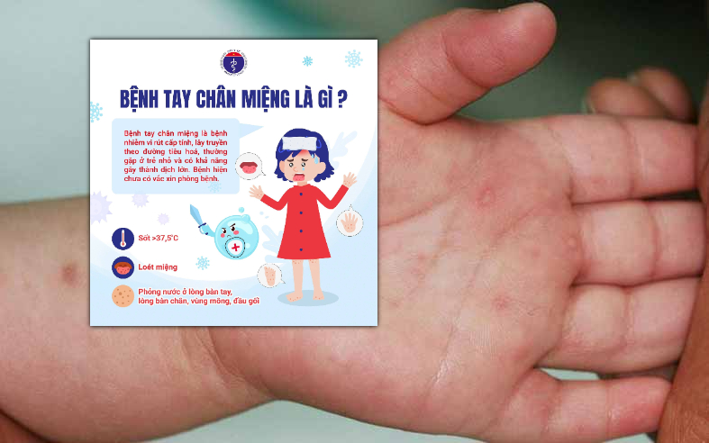 Tay chân miệng có xu hướng tăng sau 1 tháng mở cửa trường học- Ảnh 1.