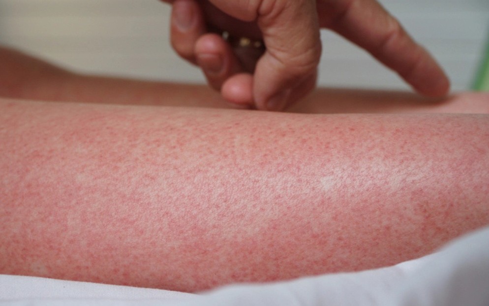 Chú ý những ổ dịch sốt xuất huyết mới ghi nhận tại Hà Nội- Ảnh 1.