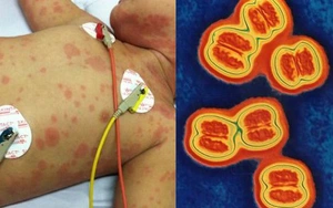 Nhận biết căn bệnh n&atilde;o m&ocirc; cầu g&acirc;y tử vong - Ảnh 3.