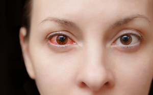 8 câu hỏi thường gặp về bệnh đau mắt đỏ