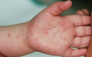 Phát hiện mới của các bác sĩ về bệnh tay chân miệng - Ảnh 1.