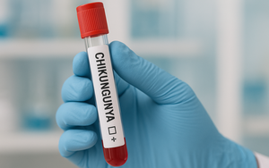 Cách phòng và điều trị bệnh Chikungunya - Ảnh 2.