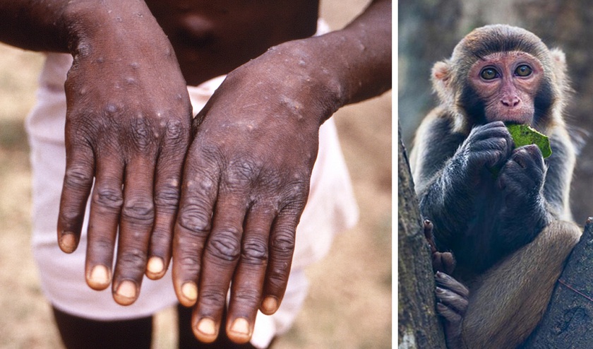Bệnh đậu mùa khỉ được phát hiện trong cộng đồng đồng tính nam  - Ảnh 1.