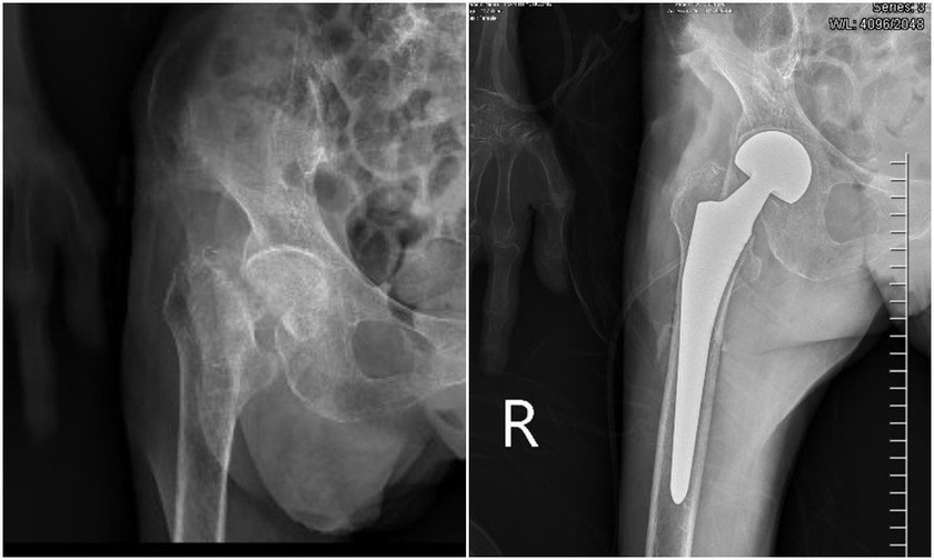 Thay khớp háng thành công cho cụ bà 107 tuổi - Ảnh 2.