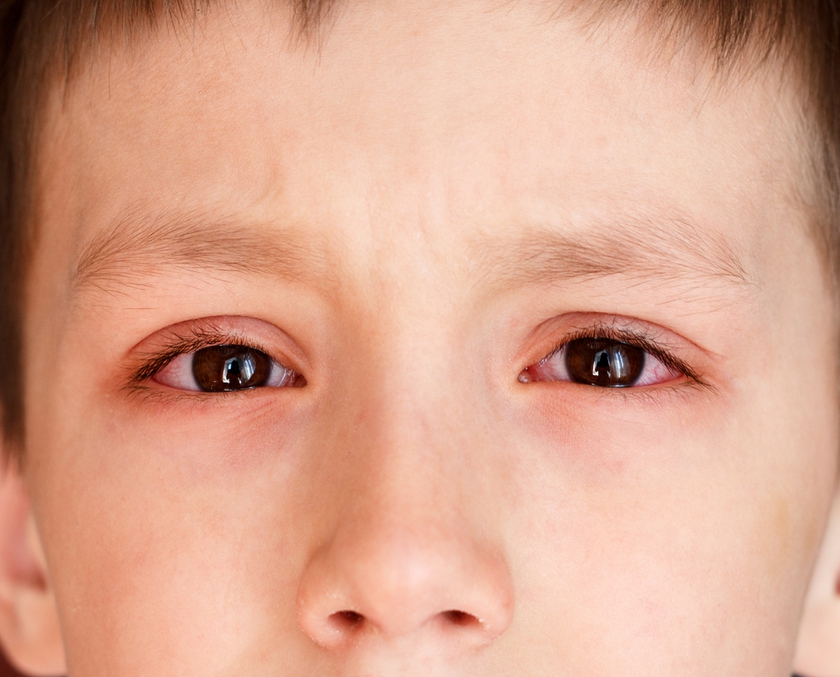 Những quan niệm sai lầm nghiêm trọng về bệnh đau mắt đỏ - Ảnh 2.