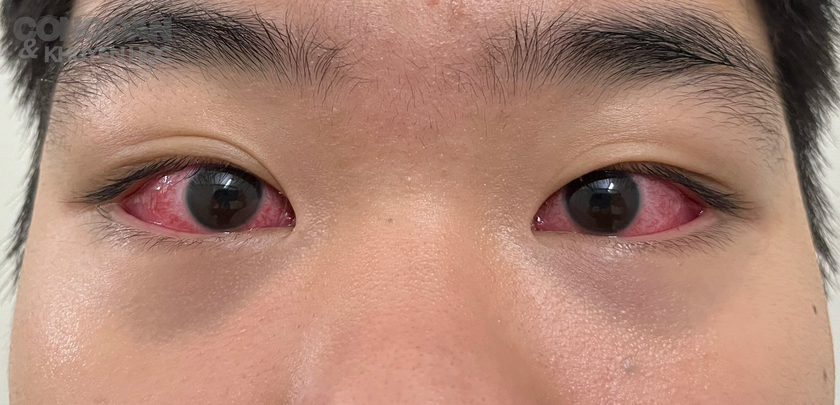8 câu hỏi thường gặp về bệnh đau mắt đỏ - Ảnh 4.