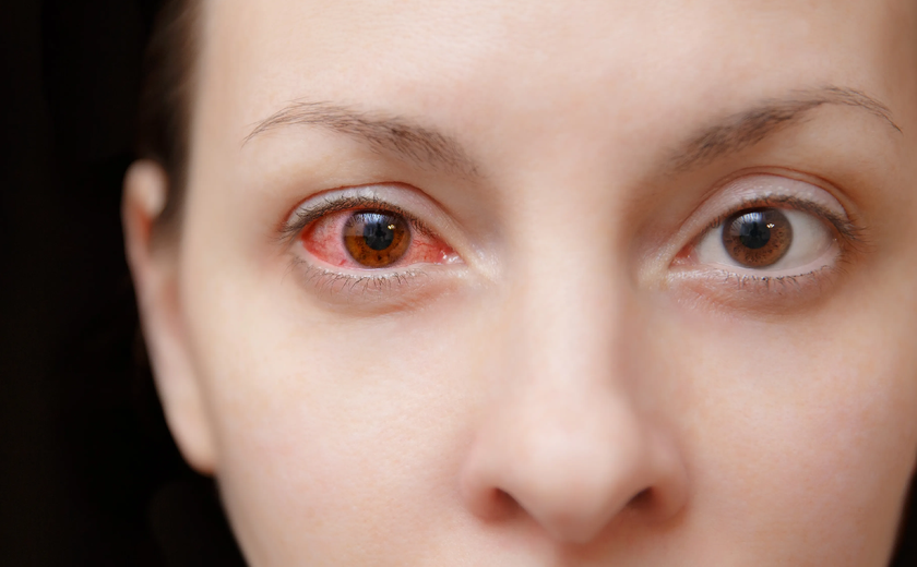 8 câu hỏi thường gặp về bệnh đau mắt đỏ - Ảnh 1.