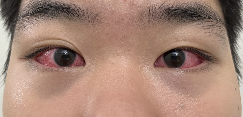 Bệnh đau mắt đỏ gia tăng, Bộ Y tế yêu cầu không để thiếu thuốc, tăng cường phòng chống dịch - Ảnh 1.