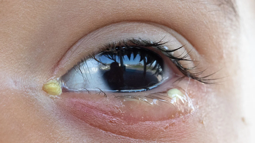 8 câu hỏi thường gặp về bệnh đau mắt đỏ - Ảnh 2.