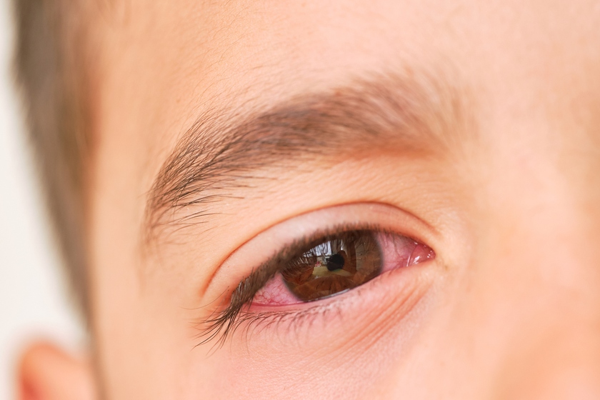 4 lưu ý quan trọng sau khi hết đau mắt đỏ - Ảnh 1.