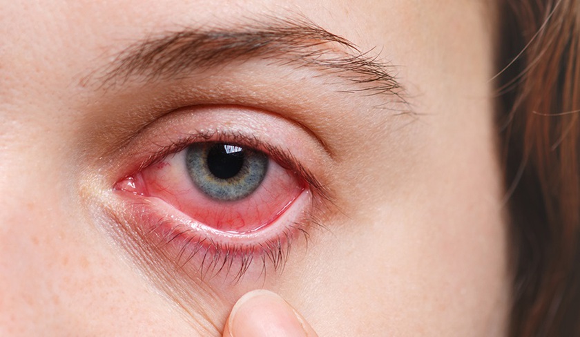 Tránh lây lan dịch đau mắt đỏ trong cộng đồng  - Ảnh 1.