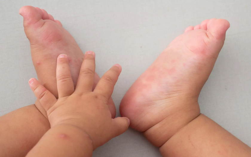 Bệnh tay chân miệng có xu hướng gia tăng. Ảnh minh hoạ: IT Bệnh tay chân miệng có xu hướng gia tăng. Ảnh minh hoạ: IT