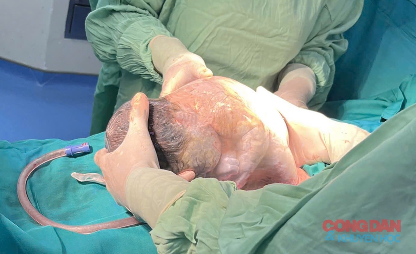 Bé gái chào đời nguyên vẹn trong túi ối hiếm gặp ở Nghệ An - Ảnh 1.