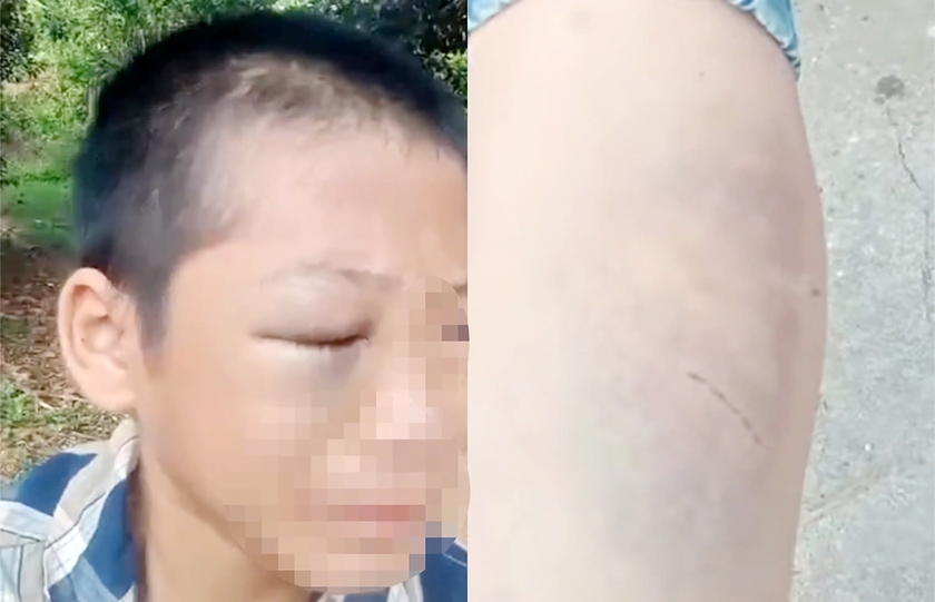 X&aacute;c minh th&ocirc;ng tin b&eacute; trai nghi bị bạo h&agrave;nh sưng h&uacute;p mặt - Ảnh 1.