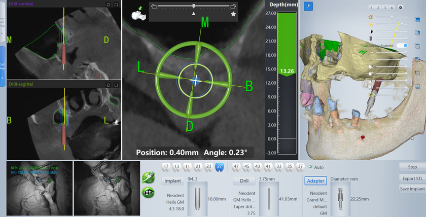 Miễn ph&iacute; 100% cơ hội trải nghiệm c&ocirc;ng nghệ AI "GPS" dẫn đường trong trồng răng Implant tại BV Th&aacute;i Thượng Ho&agrave;ng - Ảnh 2.