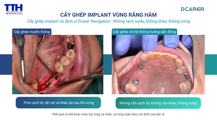 Miễn ph&iacute; 100% cơ hội trải nghiệm c&ocirc;ng nghệ AI "GPS" dẫn đường trong trồng răng Implant tại BV Th&aacute;i Thượng Ho&agrave;ng - Ảnh 3.