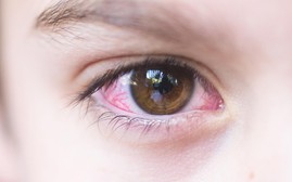 4 lưu ý quan trọng sau khi hết đau mắt đỏ