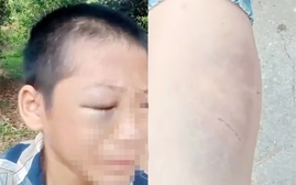 Xác minh một học sinh lớp 6 nghi bị bạo hành sưng húp mặt