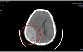Nam thanh niên xuất huyết não sau khi đi bơi