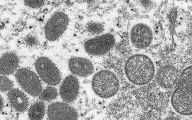 Virus gây bệnh đậu mùa khỉ tiếp tục lây lan trên toàn cầu