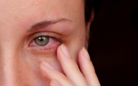 Bệnh đau mắt đỏ gia tăng, Bộ Y tế yêu cầu không để thiếu thuốc, tăng cường phòng chống dịch
