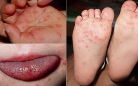 Số ca sởi giảm, một dịch bệnh khác có dấu hiệu xem bong da truc tiep ngoai hang anh ca