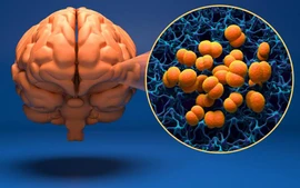 Nhận biết căn bệnh não mô cầu gây tử vong