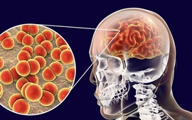 Bộ Y tế: Nhiều ca bệnh não mô cầu chuyển nặng