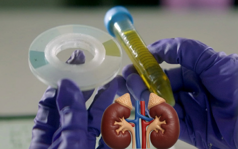 Viên tẩy bồn cầu Urify có khả năng chẩn đoán bệnh thận