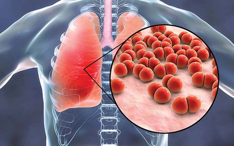 Đừng để cúm A biến chứng nặng viêm phổi