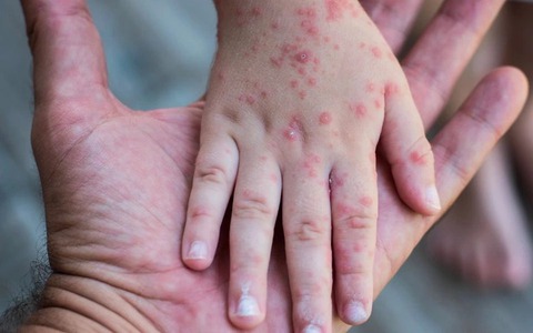 Bộ Y tế đề nghị các địa phương tiếp tục rà soát các đối tượng chưa tiêm vaccine sởi