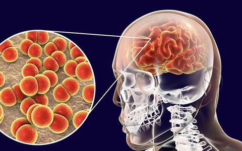 Bộ Y tế: Nhiều ca bệnh não mô cầu chuyển nặng