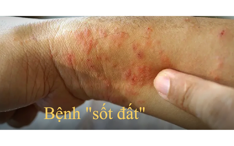 Bệnh "sốt đất" ở Thái Lan - đi du lịch Thái Lan nên lưu ý gì?