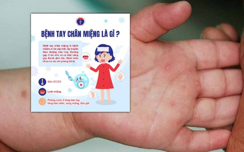 Dịch bệnh tay chân miệng tăng mạnh: Gần 100.000 ca trong 8 tháng